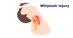 Whiplash injury